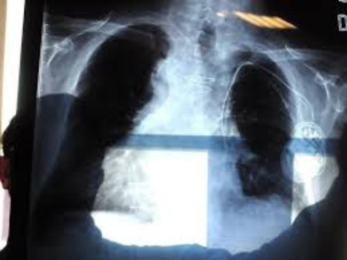 Morto per mesotelioma da amianto, condannato il ministero della Difesa