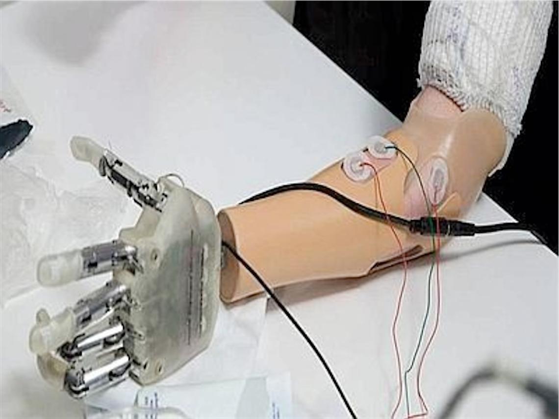 Il pensiero muove la nuova mano bionica