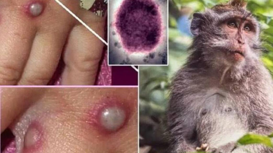Vaiolo delle scimmie in Italia, sintomi e come si trasmette
