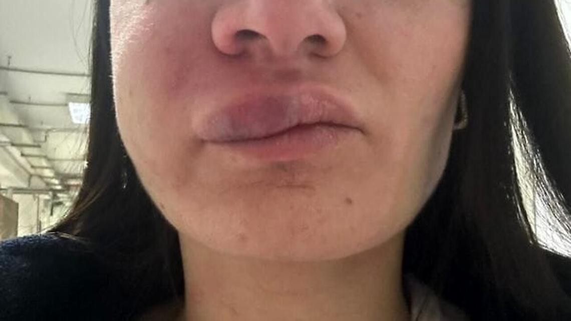 Pugni a infermiera, giudizio immediato per l'aggressore
