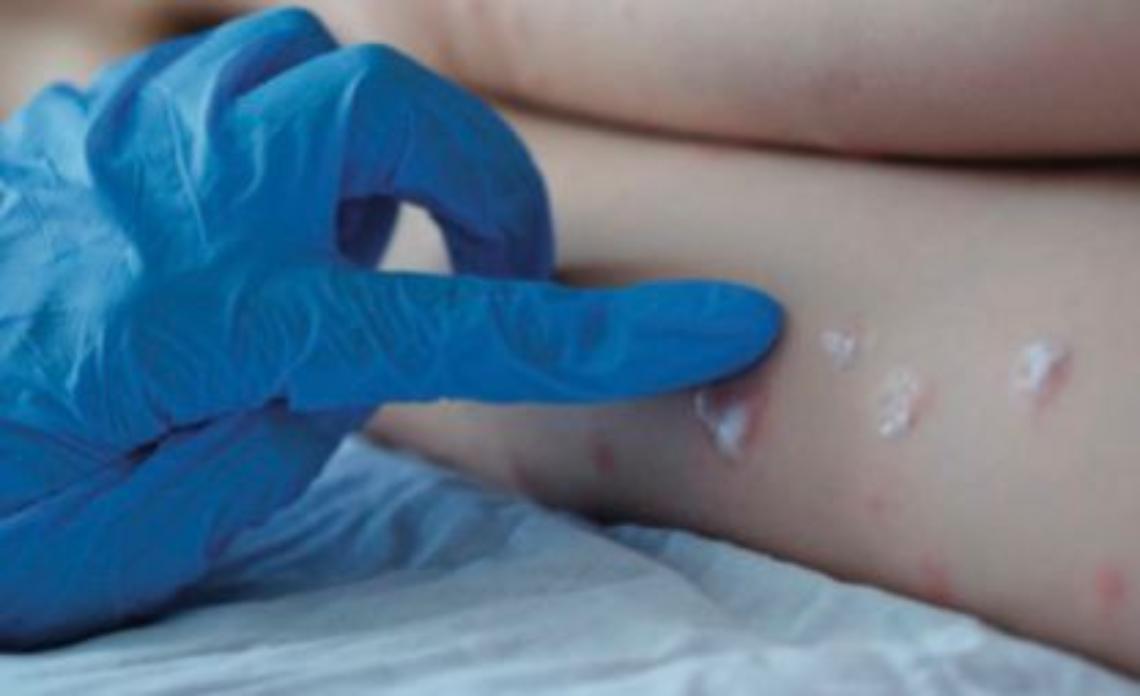 Vaiolo delle scimmie in 12 Paesi