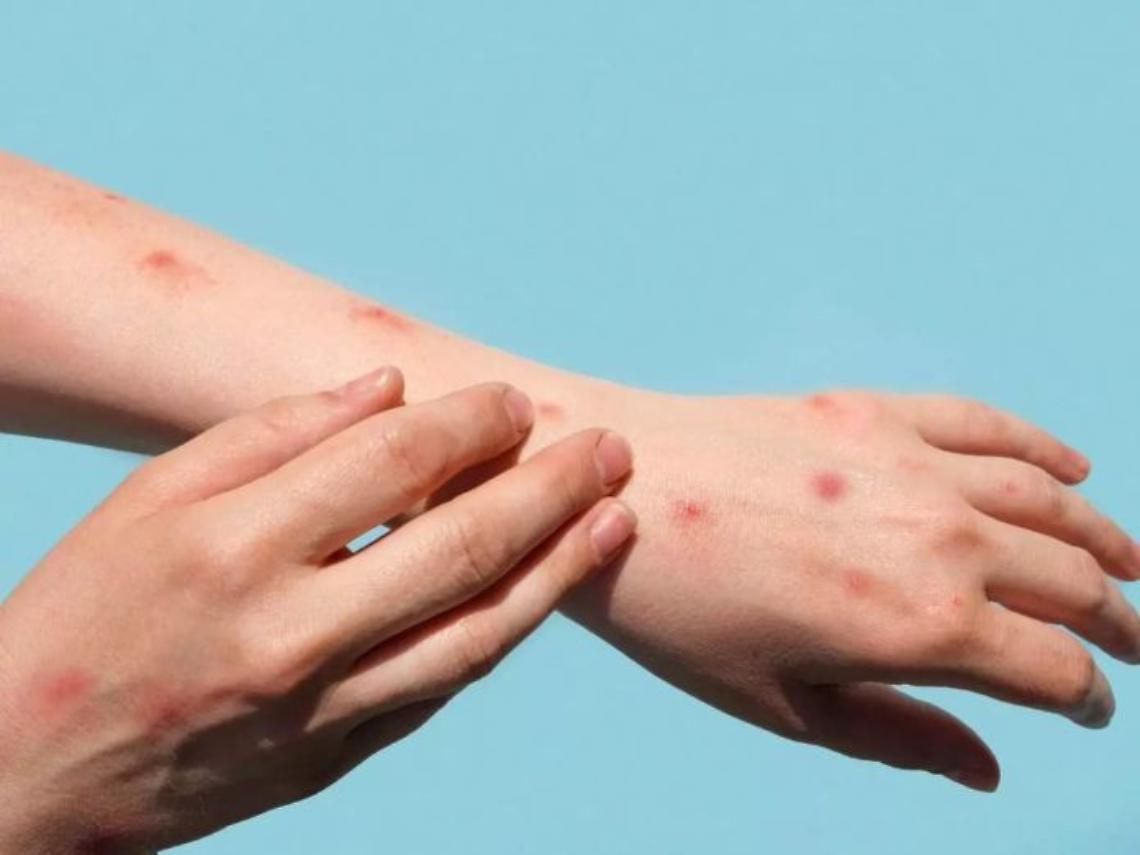 Vaiolo delle scimmie: Rezza, massima attenzione ma non allarmismo