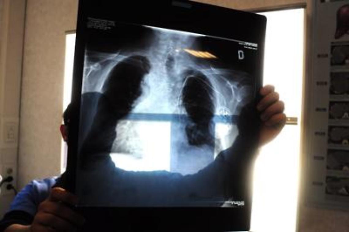 Allarme Covid-19: polmoni a rischio per 6 mesi