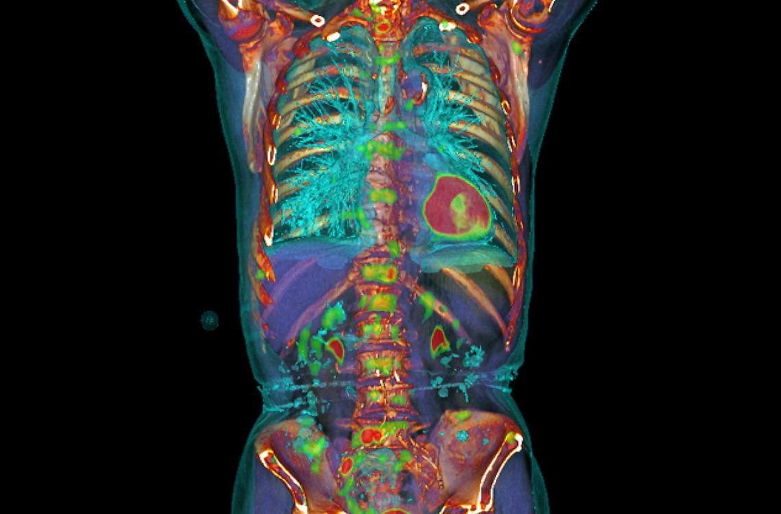 Inaugurati i primi webinar in radiologia oncologica 
