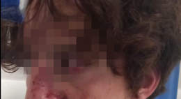 A 16 anni vittima di un raid punitivo dopo una lite con una ragazza