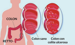 Colite ulcerosa: in Campania ne soffrono circa 8mila pazienti
