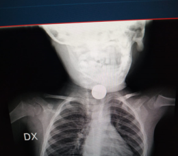 Ingerisce pila a disco, bimbo di 2 anni salvato al Santobono