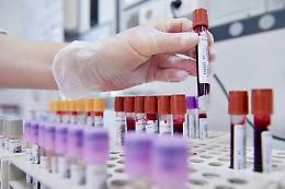 Aids, una nuova tecnica elimina il virus