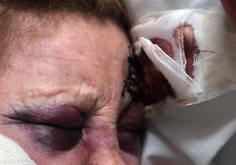 Anziana scippata e massacrata a due passi dal Lungomare