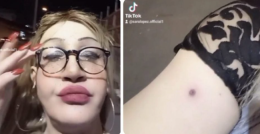 Transgender ferita con pallini di gomma a Pompei